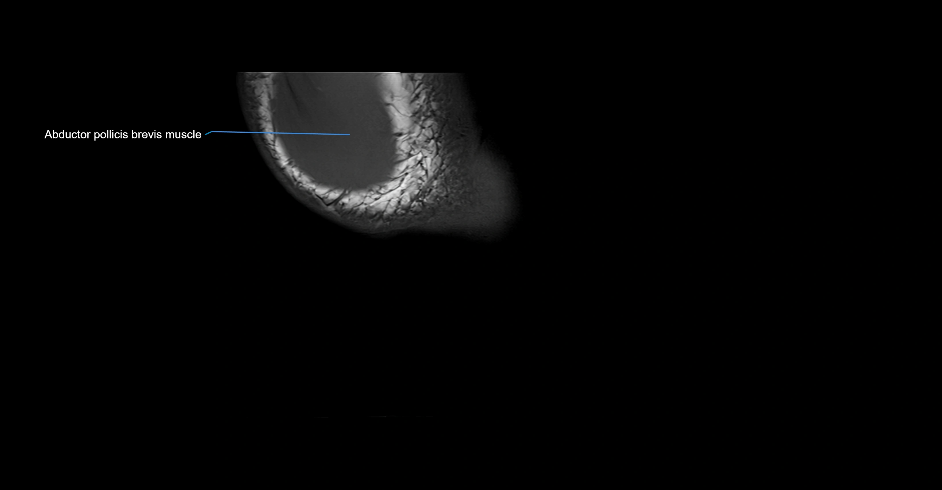MRI wrist coronal cross sectional anatomy 3T  radiology  image-img-00001-00028.webp